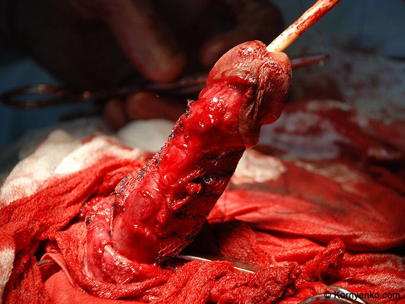 Installation of a collagen matrix for penis enlargement