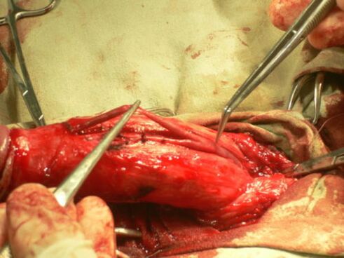 Performing penis enlargement surgery