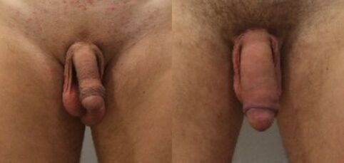 before and after penis enlargement surgery