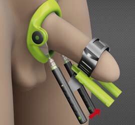 Rehabilitation after penis enlargement surgery